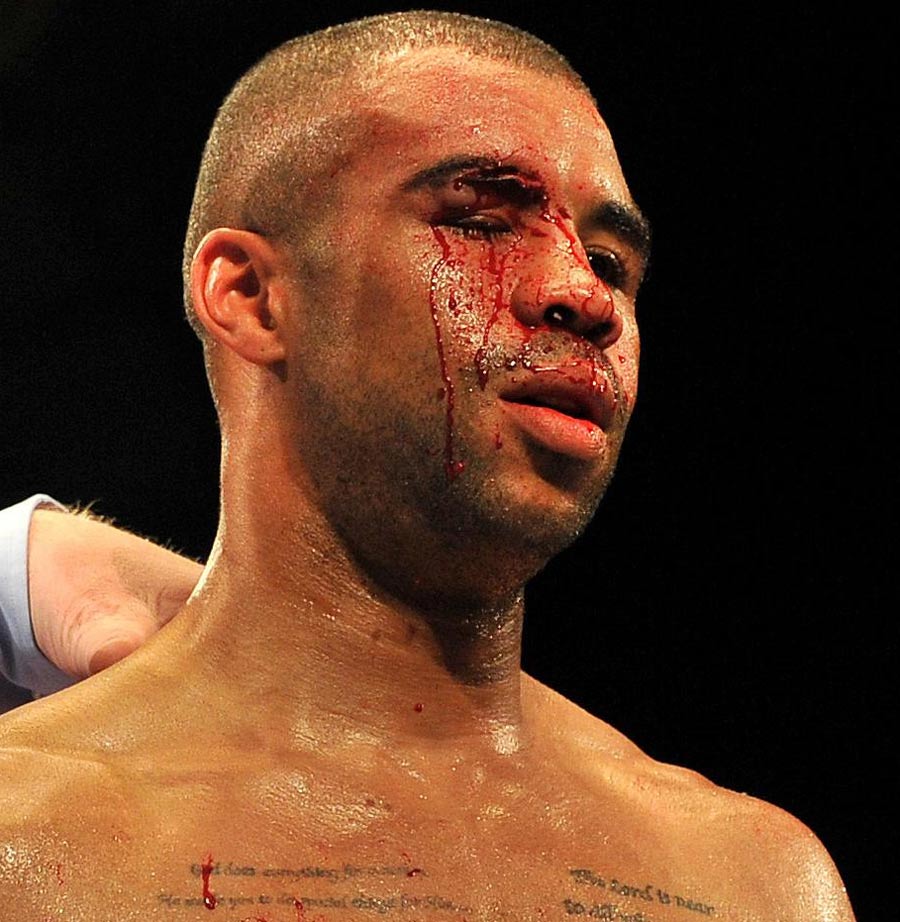 Rendall Munroe with a cut above his eye after an accidental headbutt from Scott Quigg