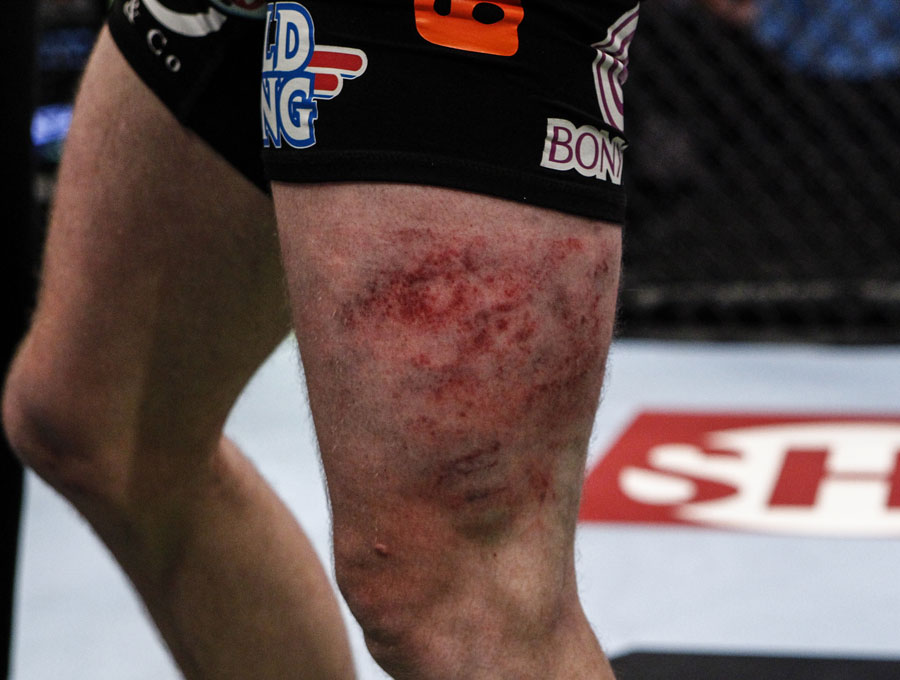 Damage from kicks are seen on Nate Marquardt's leg after his bout against Tarec Saffiedine