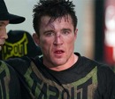 Chael Sonnen shows the scars of battle with Nate Marquardt